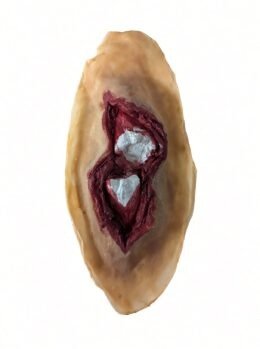 Broken Bone | Sharpe Mark Prosthetics